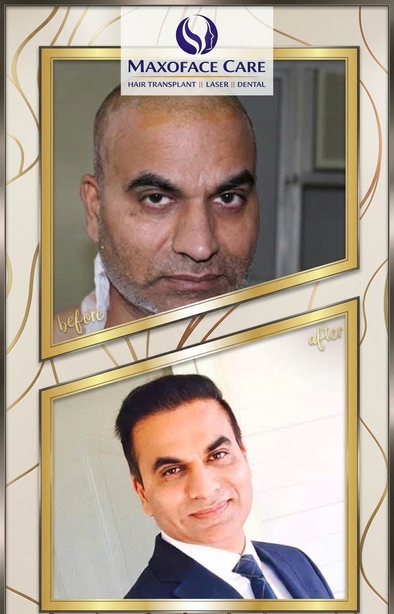Dramatic Hairline Restoration
